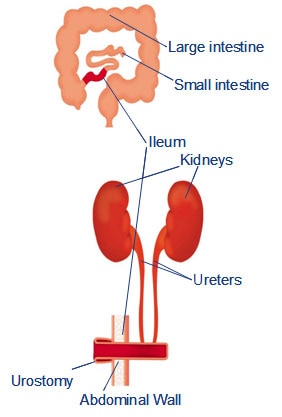 Urostomia