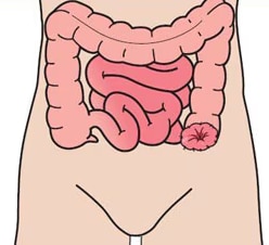 Colostomia