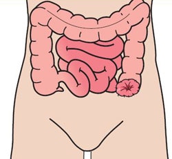 Colostomia