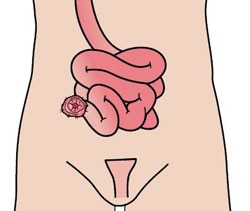 Ileostomia