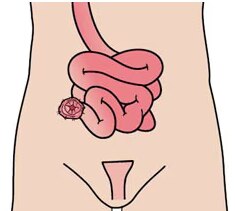 Ileostomia