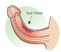 tecido cicatricial peniano