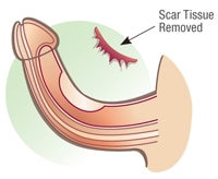 remoção de tecido cicatricial peniano