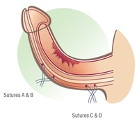 cirurgia peniana