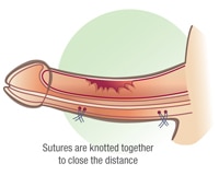 Cirurgia de Peyronie