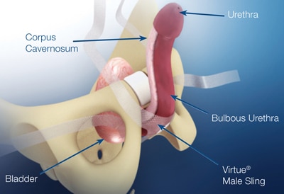 cirurgia de sling para incontinência masculina