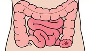 O que é uma colostomia?